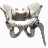 This artificial hip together with the integrated joint replaces all of the bone affected by cancer. The illness of the 15-year-old boy spread quickly, so the implant had to be available as fast as possible (courtesy of Instrumentaria)