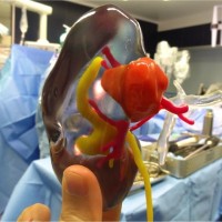 Using Stratasys' transparent VeroClear material enables Dr Bernhard to see inside the kidney and estimate the specific location and depth at which the tumor resides.
